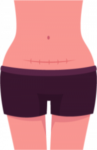 Eletronterapia e Betaterapia para Queloide